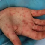 Viruela del mono: detectaron el primer caso en Argentina de la variante más agresiva y contagiosa